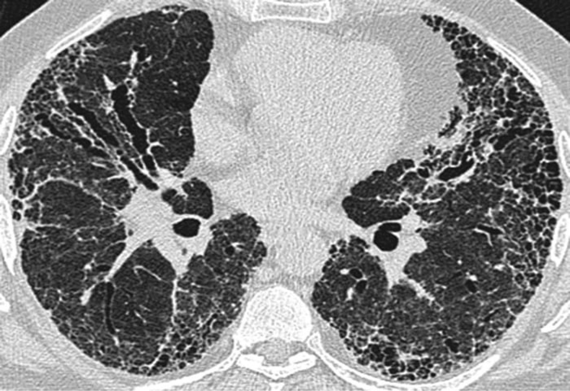 Ra Pulmonary Fibrosis CT