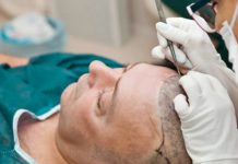 Hair Transplant For People With Curly Hair